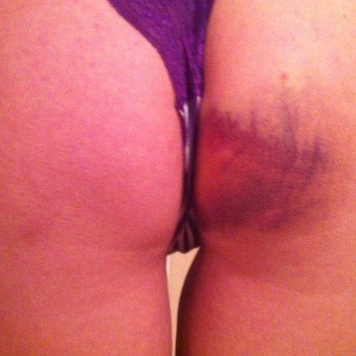 most common sex injuries