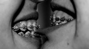 kissing-with-braces-frequently-aske_2