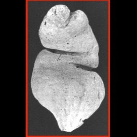 cement in rectum