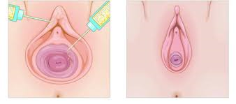 Vaginal Fillers to tighten vagina