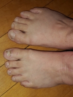 My Ugly Feet