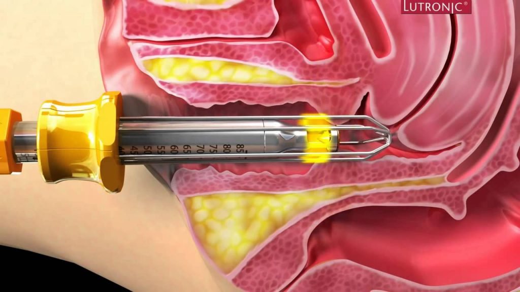 CO2 Lasers for vagina tightening