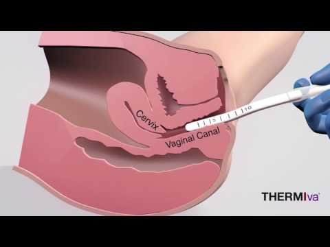 Radiofrequency to tighten vagina