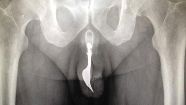 Removing stuck objects from bad bdsm