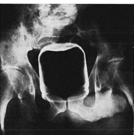Peanut butter jar up butt xray
