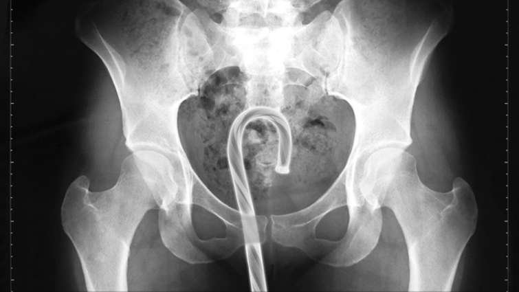 butt xray