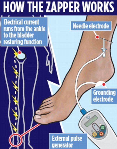 Safety first when using ankle zap