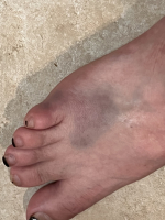 Broken Toes cover image