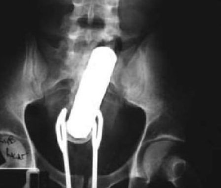 Playing Operation fetish